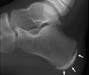 xray showing a juvenile calcaneus with growth plate open